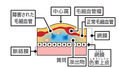 正常な状態と糖尿病網膜症、糖尿病黄斑浮腫の比較図 正常な状態と糖尿病網膜症、糖尿病黄斑浮腫の比較図