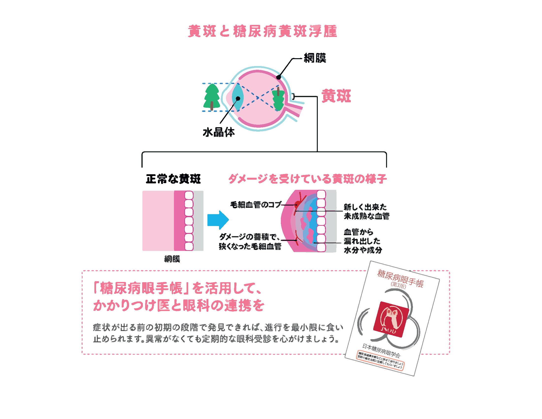 黄斑と糖尿病黄斑浮腫 黄斑と糖尿病黄斑浮腫