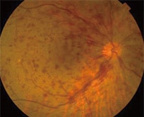 眼底検査の図 網膜中心静脈閉塞症 眼底検査の図 網膜中心静脈閉塞症