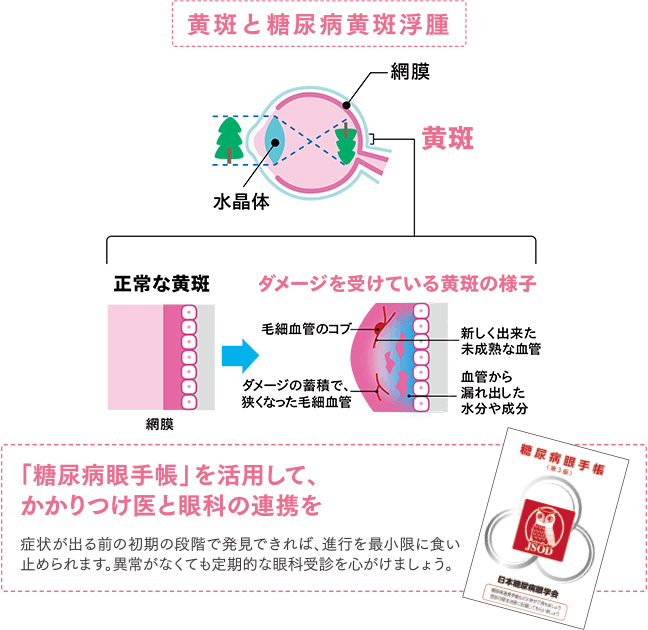 黄斑と糖尿病黄斑浮腫
