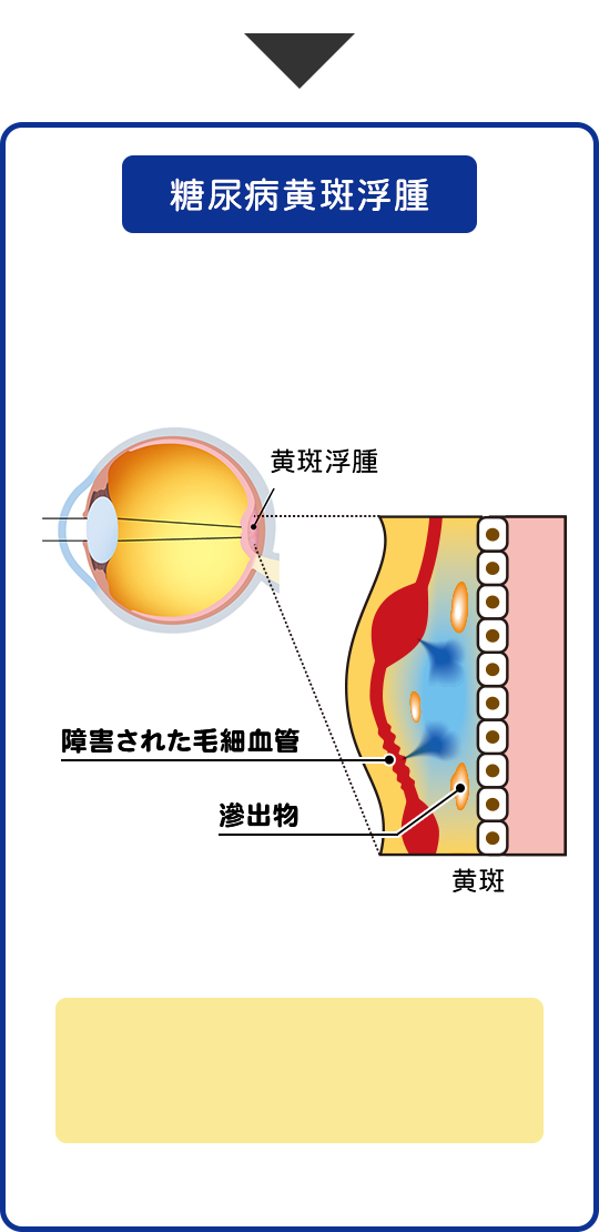 糖尿病黄斑浮腫