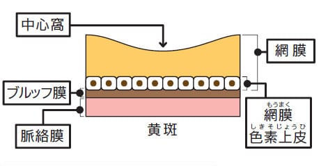 正常な状態と病的近視における脈絡膜新生血管の比較図
