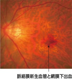 眼底検査の図 病的近視における脈絡膜新生血管