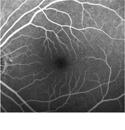 蛍光眼底造影の図 正常