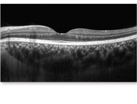 光干渉断層計（OCT）の図 正常