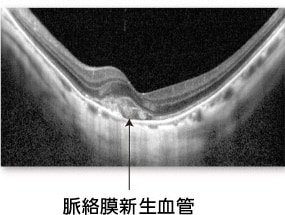 光干渉断層計（OCT）の図 病的近視における脈絡膜新生血管