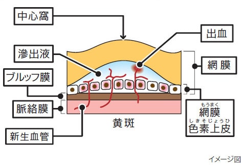 正常な状態と病的近視における脈絡膜新生血管の比較図