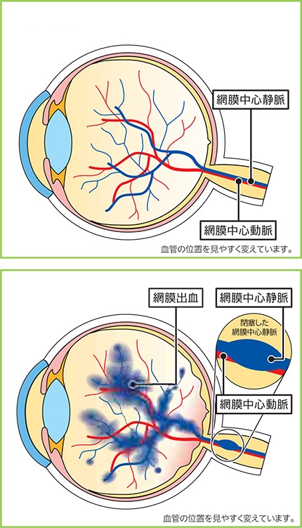 正常な状態 網膜中心静脈閉塞症