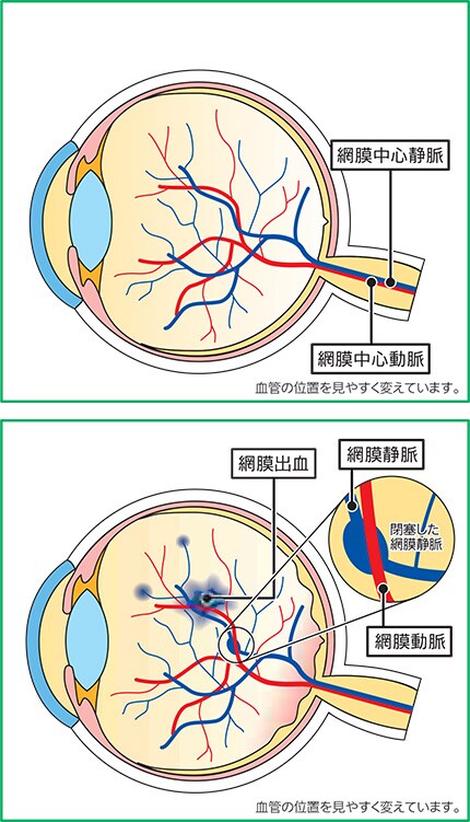 正常な状態 網膜静脈分枝閉塞症