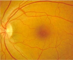 眼底検査の図 正常