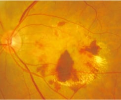 眼底検査の図 滲出型加齢黄斑変性