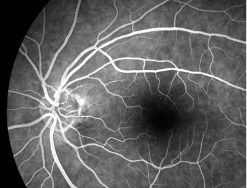 蛍光眼底造影の図 正常