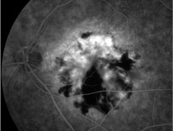 蛍光眼底造影の図 滲出型加齢黄斑変性