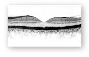 光干渉断層計（OCT）の図 正常