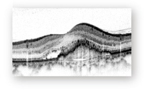 光干渉断層計（OCT）の図 滲出型加齢黄斑変性