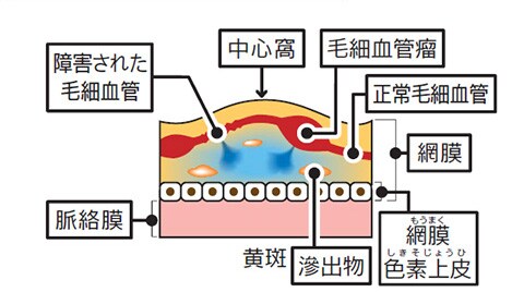 正常な状態と糖尿病網膜症、糖尿病黄斑浮腫の比較図