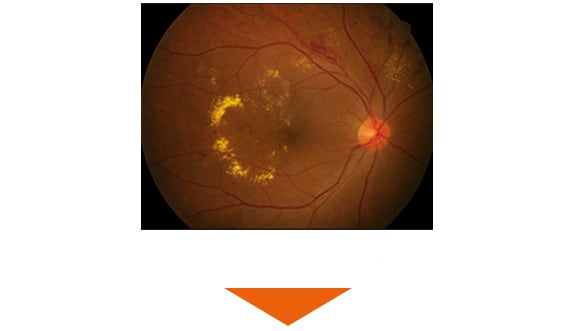 毛細血管瘤／点状網膜出血