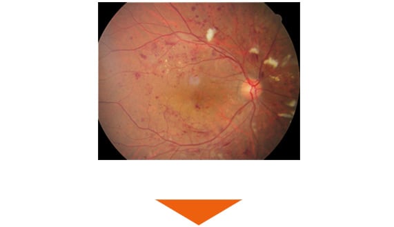 血管閉塞／虚血