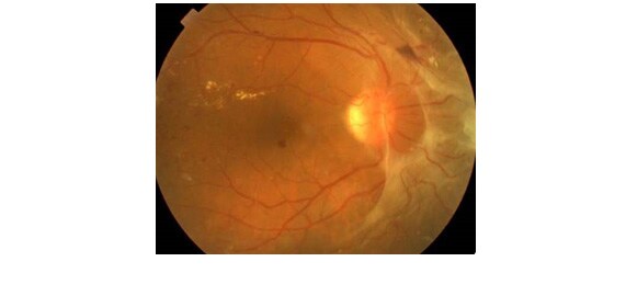 新生血管／出血／牽引性網膜剥離