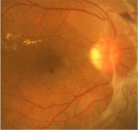 糖尿病網膜症、糖尿病黄斑浮腫