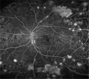 糖尿病網膜症、糖尿病黄斑浮腫