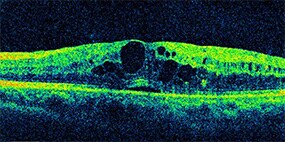 糖尿病網膜症、糖尿病黄斑浮腫