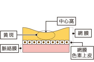 正常な状態と滲出型加齢黄斑変性の比較図