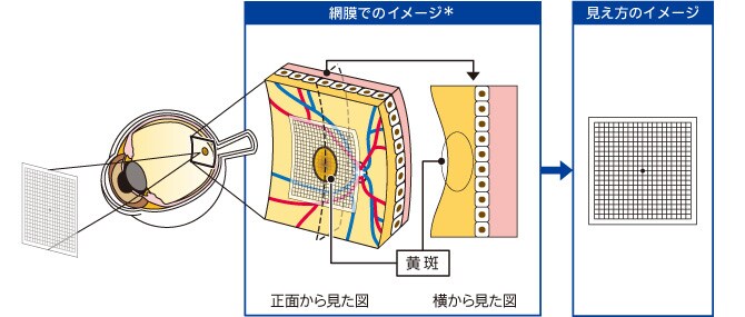 正常な状態での見え方の図