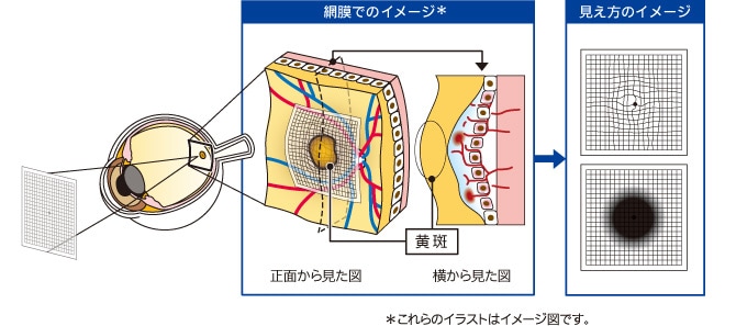 滲出型加齢黄斑変性の図