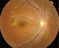 眼底検査の図 正常