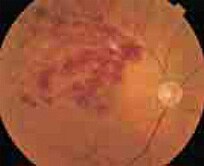 眼底検査の図 網膜静脈分枝閉塞症