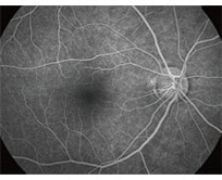蛍光眼底造影の図 正常