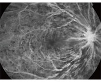 蛍光眼底造影の図 網膜中心静脈閉塞症