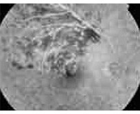 眼底検査の図 網膜静脈分枝閉塞症