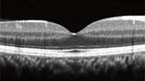 光干渉断層計（OCT）の図 正常
