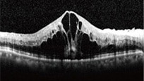 光干渉断層計（OCT）の図 網膜中心静脈閉塞症