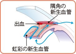 新生血管ができたとき