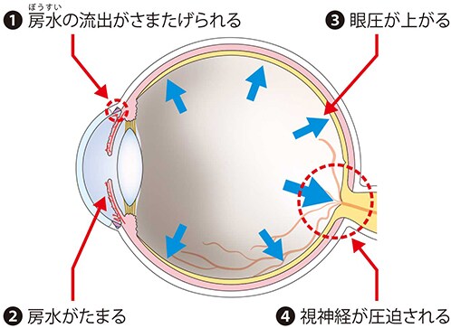 血管新生緑内障