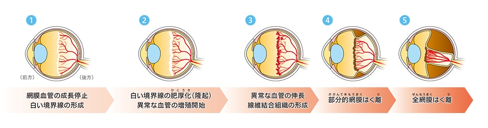 未熟児網膜症の進行