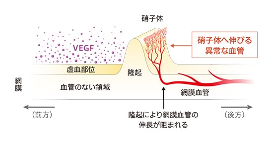 未熟児網膜症の進行